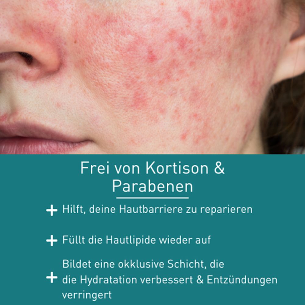 N1 Rosacea Crème – beruhigt und lindert Rötungen und Juckreiz