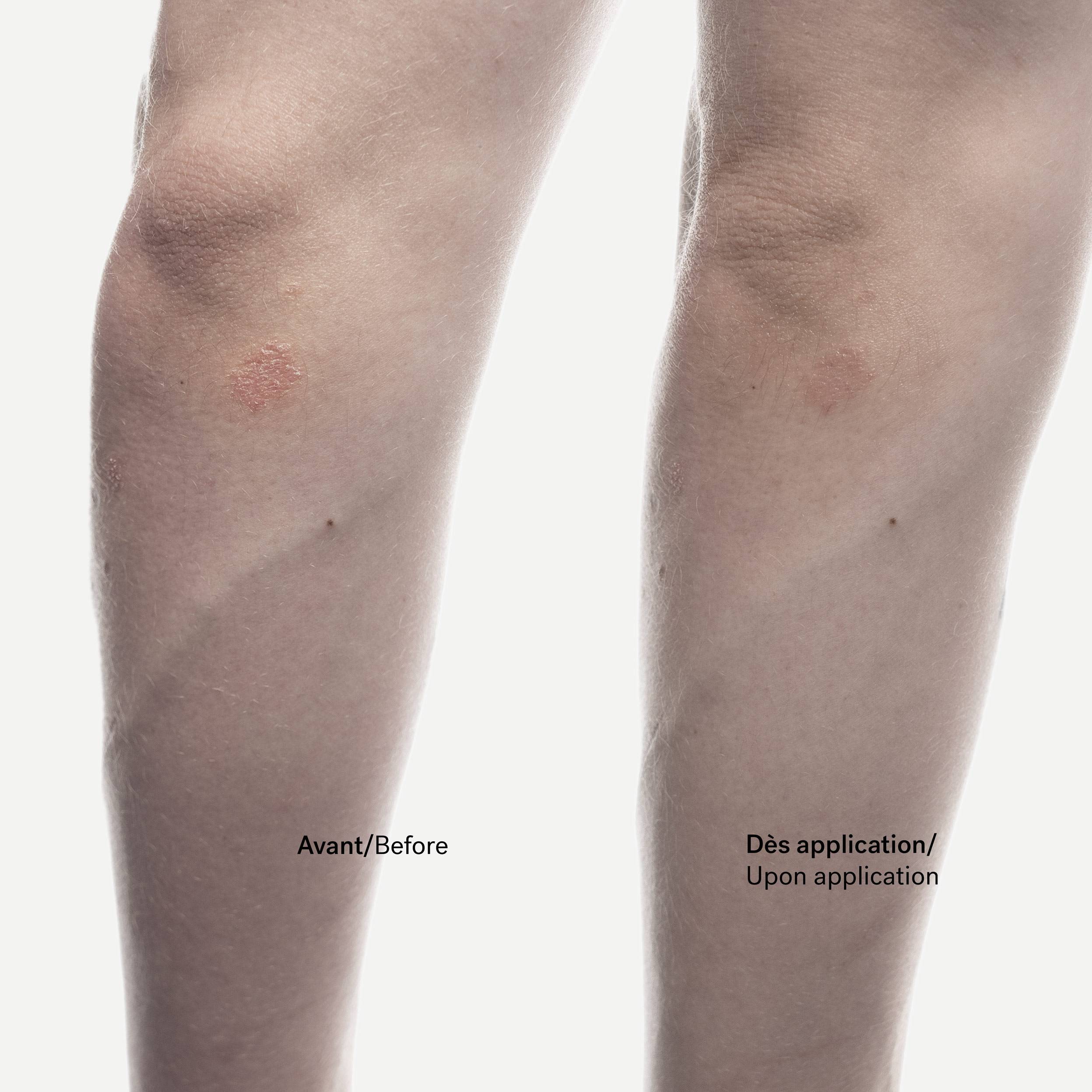C92 - Crème anti-squames<br>Phytostérols 1% + Allantoïne