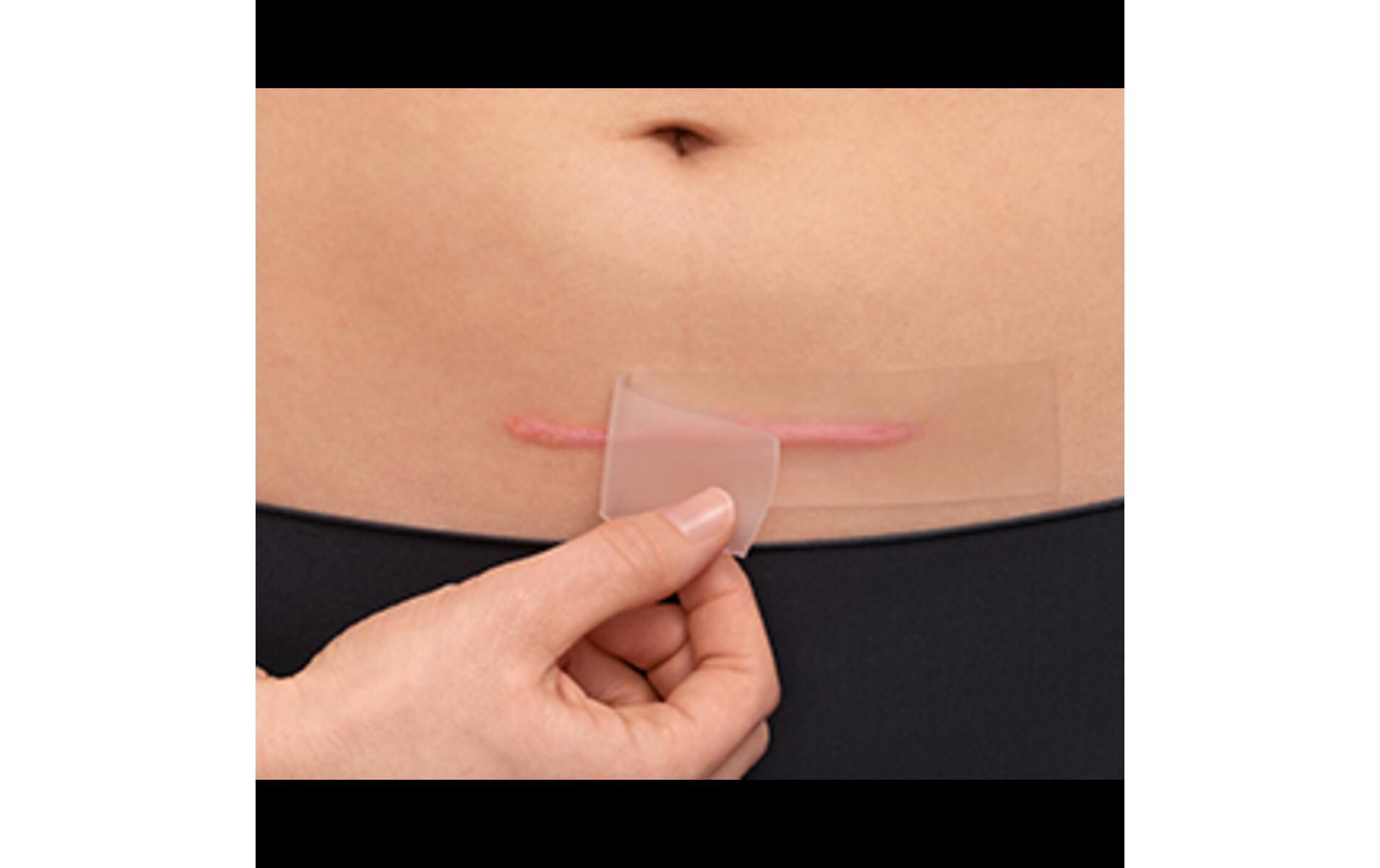 Narbenpflaster Narben Reduktion XL 21 StückPflaster zur Narbenbehandlung