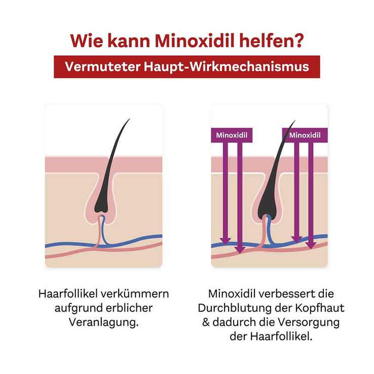 MINOXIDIL DoppelherzPharma 20 mg/ml Lösung für Frauen, 3X60 ml