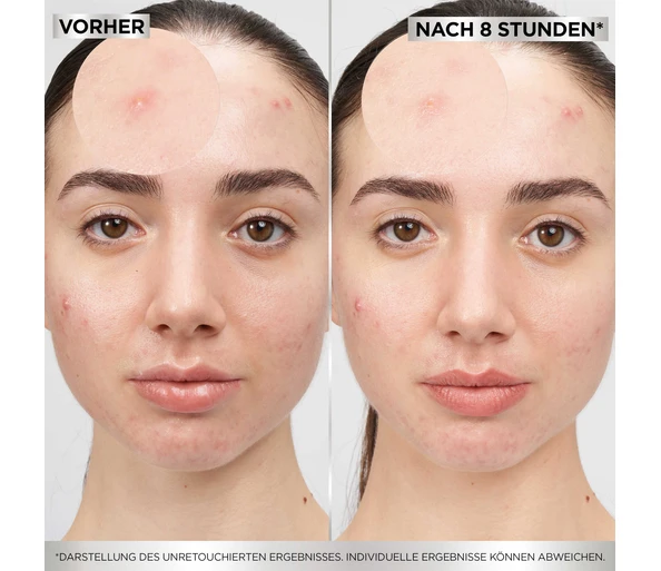 Garnier Hautklar 8H Pimple Patch