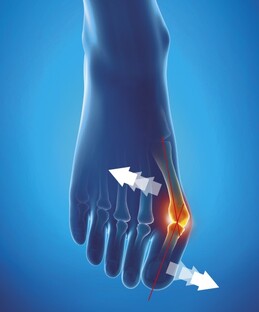 Epitact Hallux Valgus Corrigerende Orthese Maat 36-38 1ST
