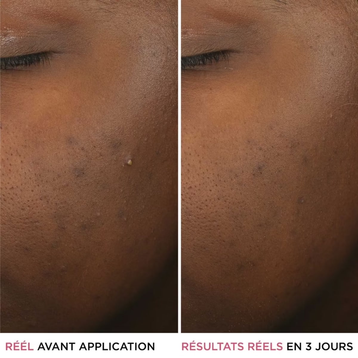 It Cosmetics Bye Bye Breakout Sérum anti-acné à l'acide salicylique
