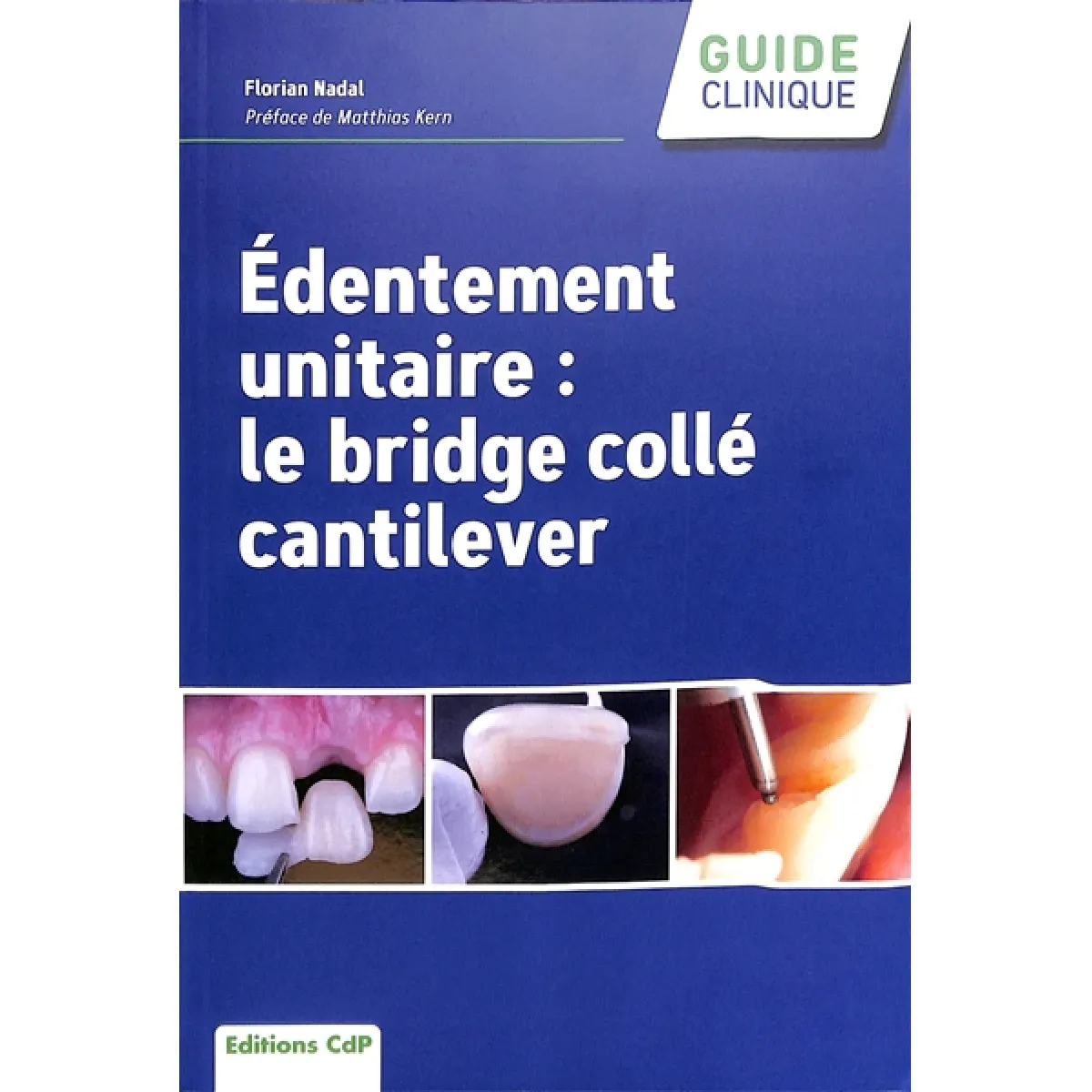 Edentement unitaire : le bridge collé cantilever