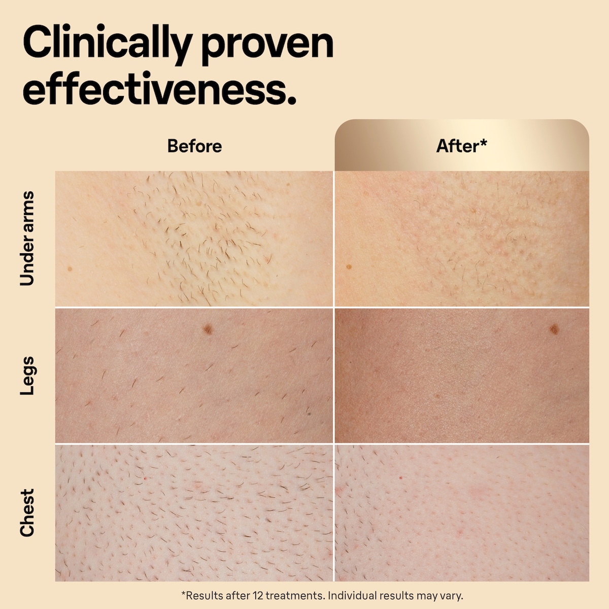 Braun IPL Silk-Expert Pro 5 hårfjernerlys PL5356