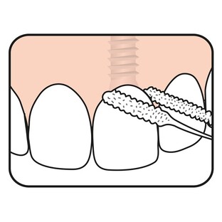 TePe Bridge & Implant Floss 30ST
