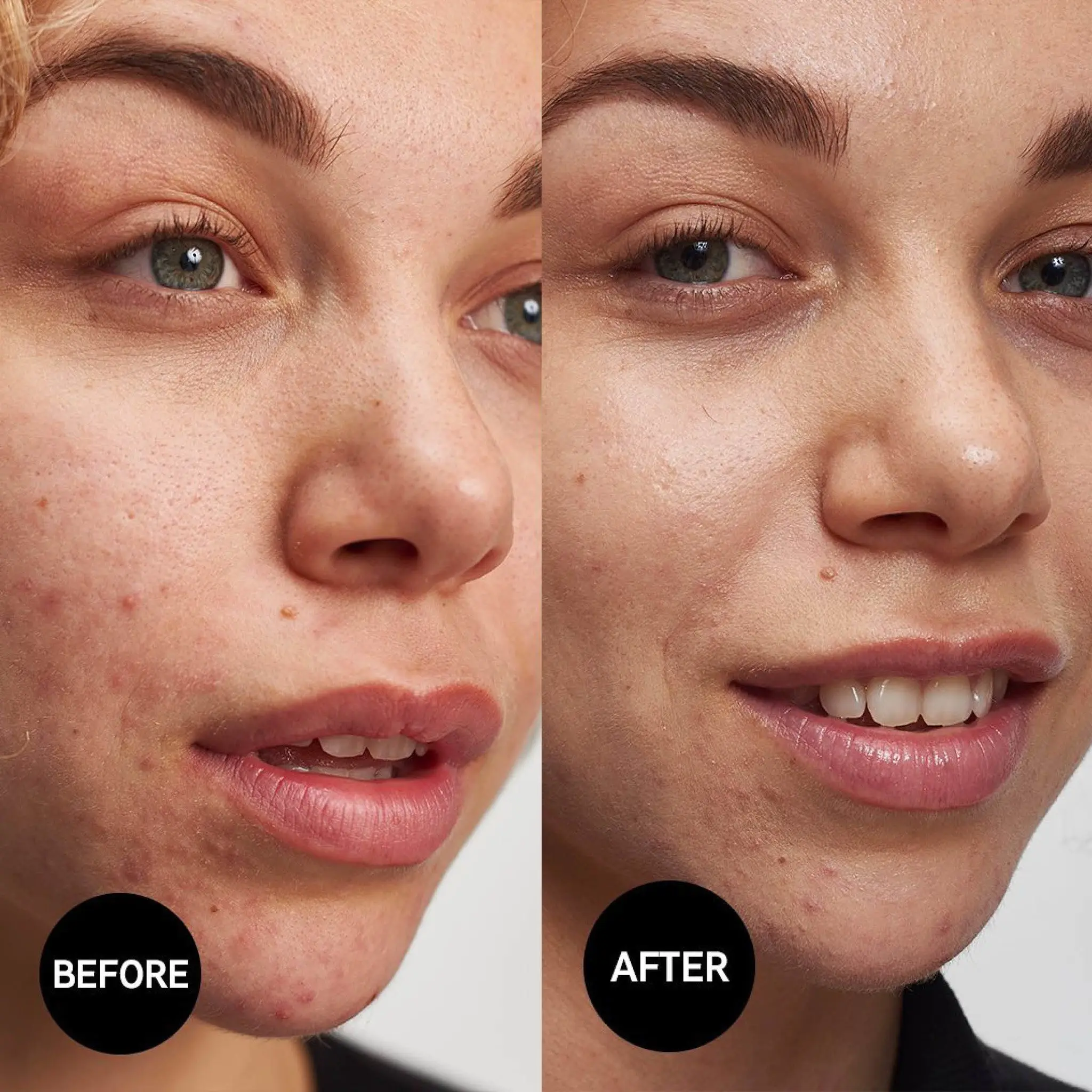 Salicylic Acid Cleanser