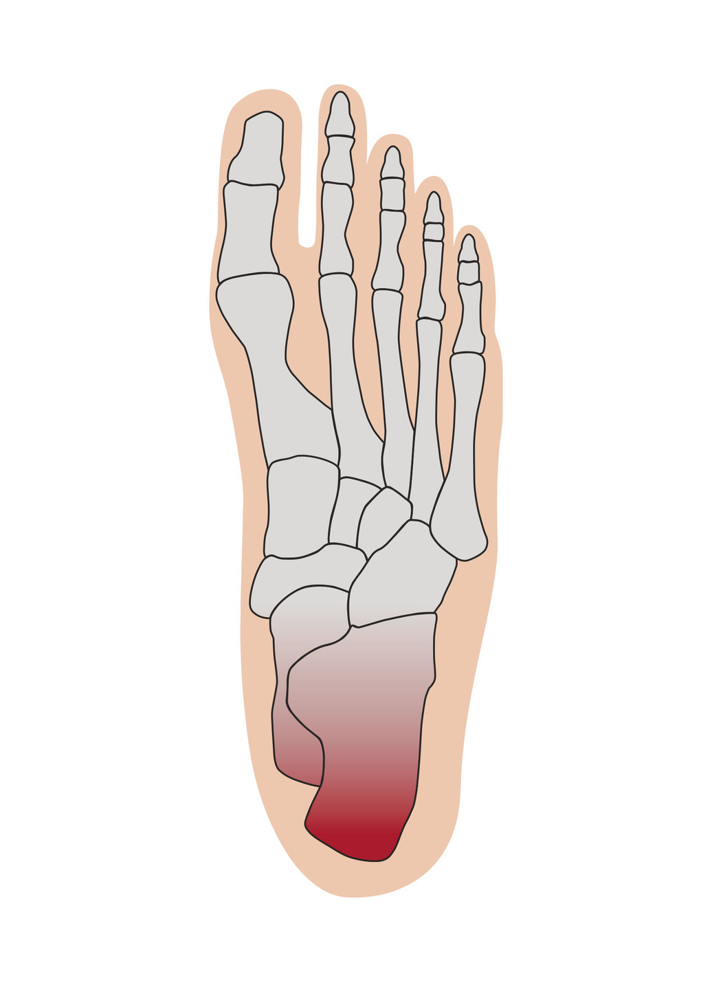 Fersenschutzbandage