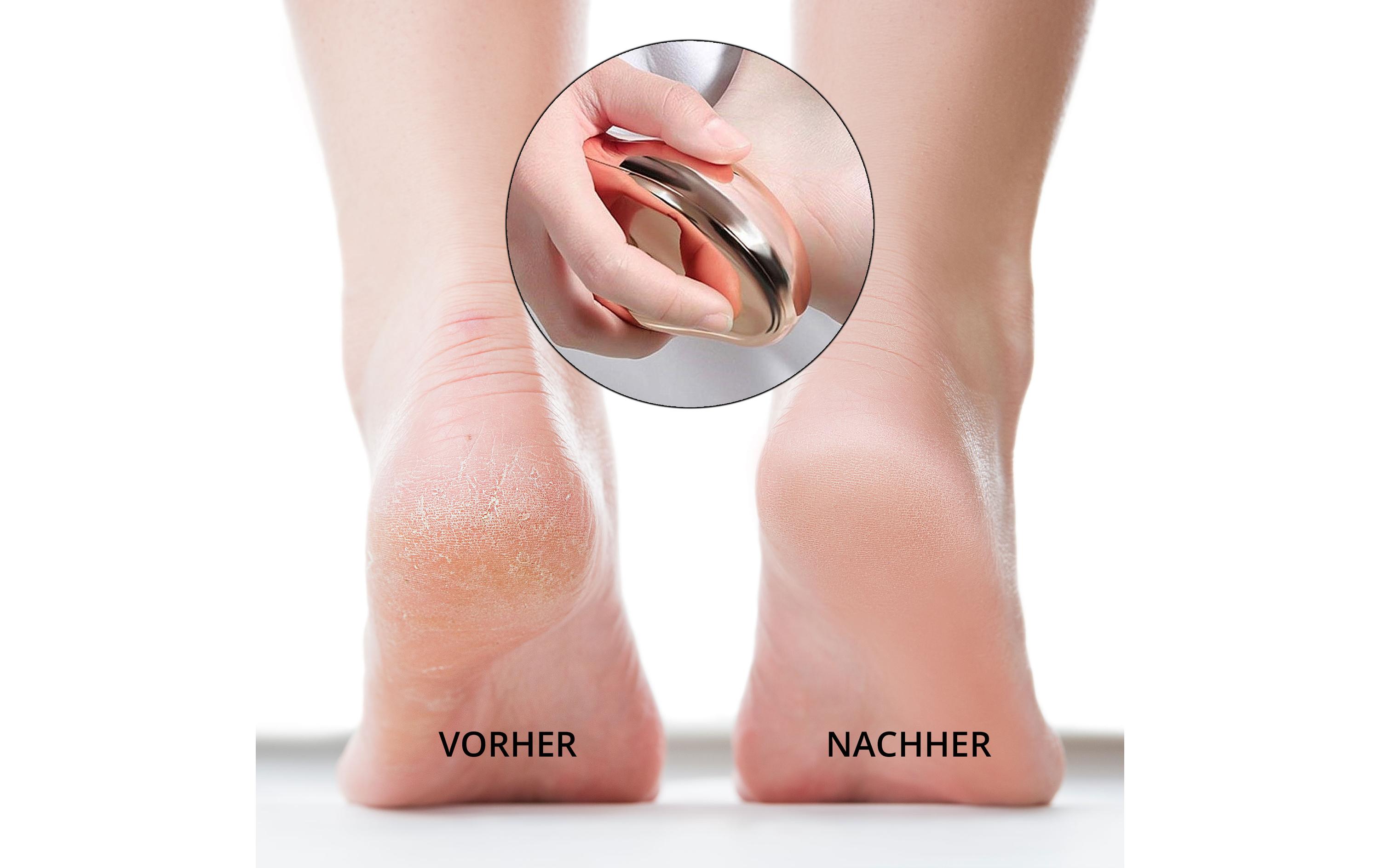 Hornhautentferner Doucette Pro LilaHornhautentfernung und Fusspflege
