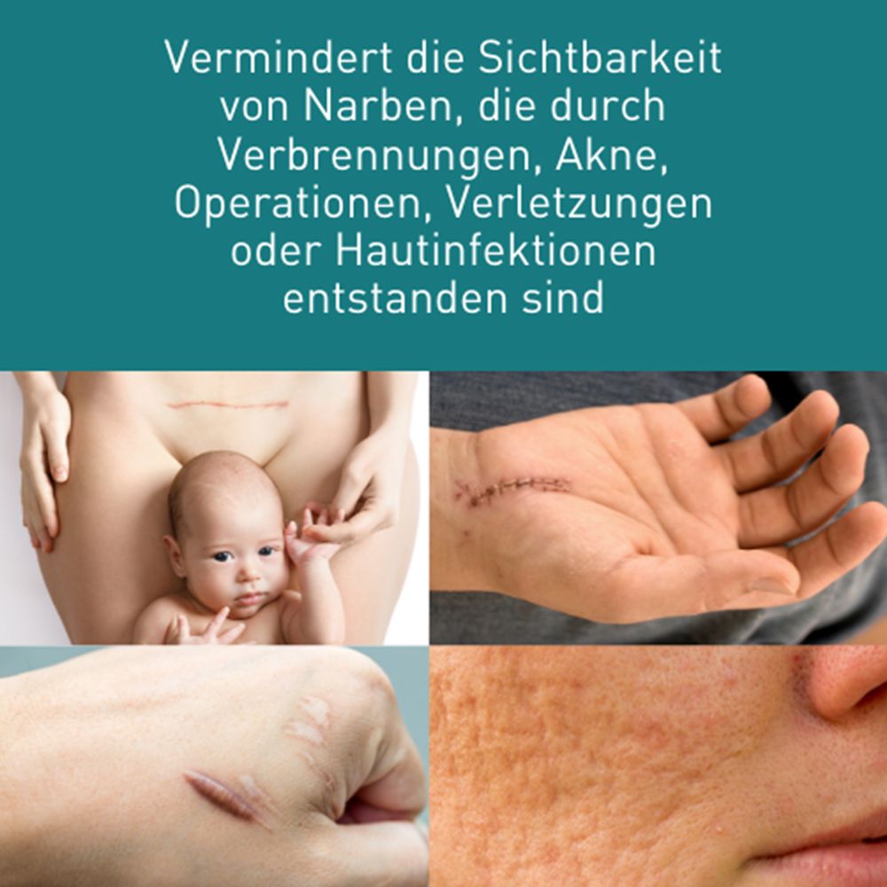 N1 Narbengel – reduziert Hautverdickungen, Rötungen, Verfärbungen & Schmerzen