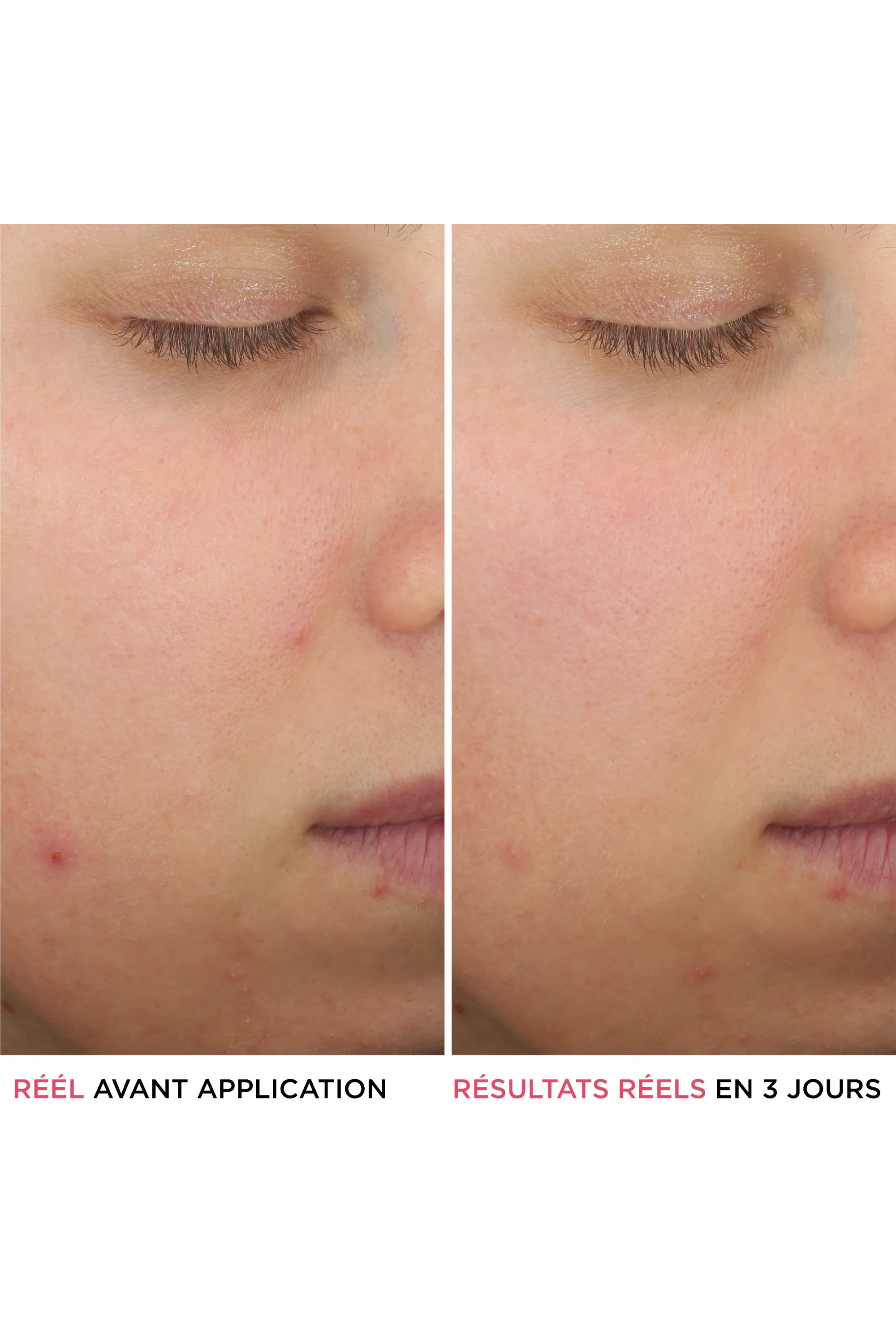 it Cosmetics Sérum anti-acné à l’acide salicylique Bye Bye Serum-30 ml