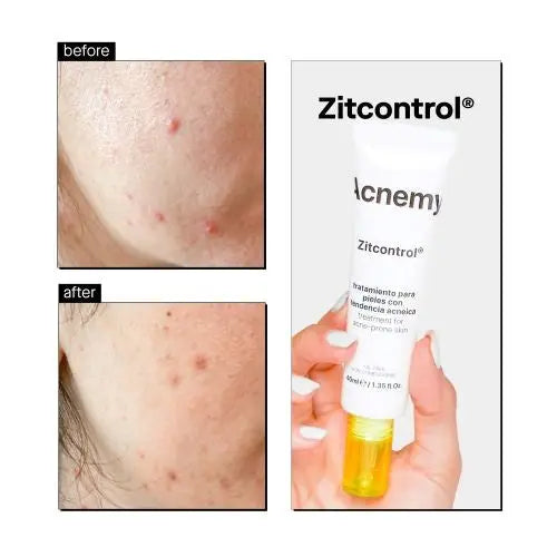 Zitcontrol Treatment Cream