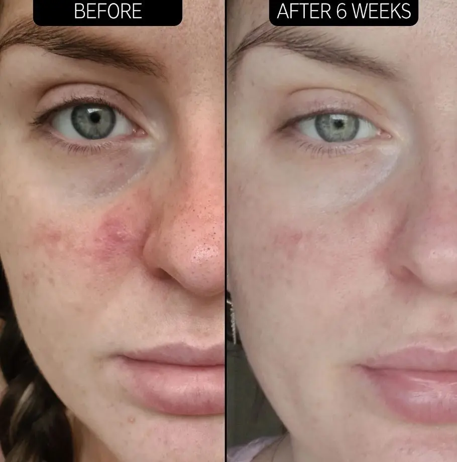 SuperSolutions Redness Relief Solution