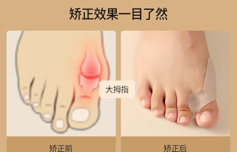Caraboomie - Valgus Teen Correctie Brace (Diverse Ontwerpen)