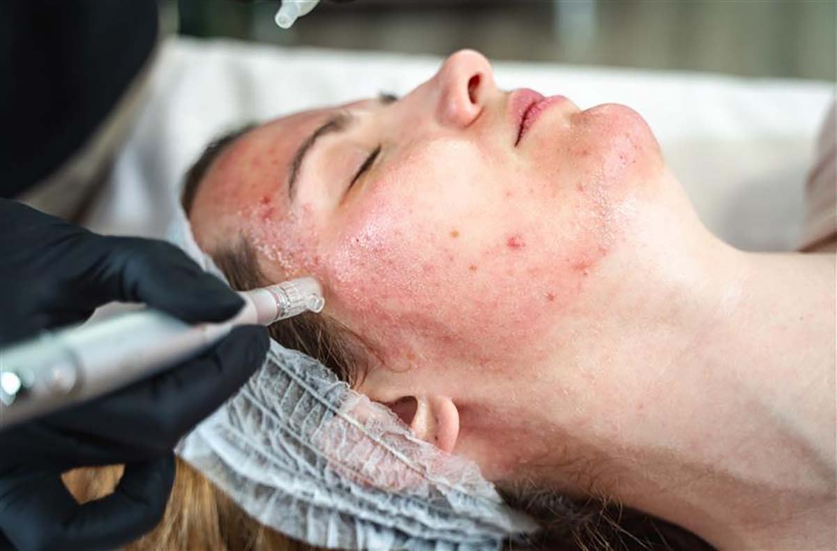 Microneedling Ingolstadt
