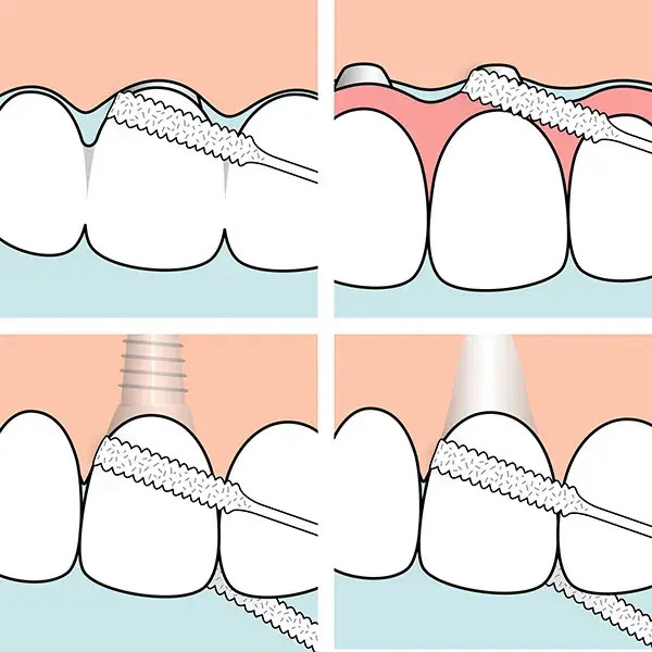 TePe Fil Dentaire Spécial Implants 30 pièces