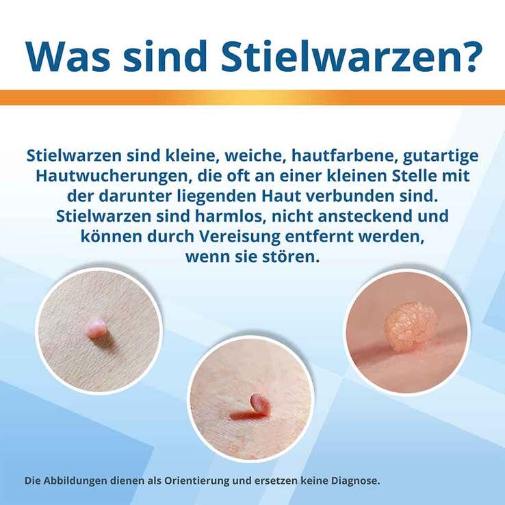 EndWarts® Extra gegen Stielwarzen, 14.3 g