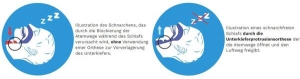 SOMNOFIT-S Kiefer Orthese Apnoe Schnarchen