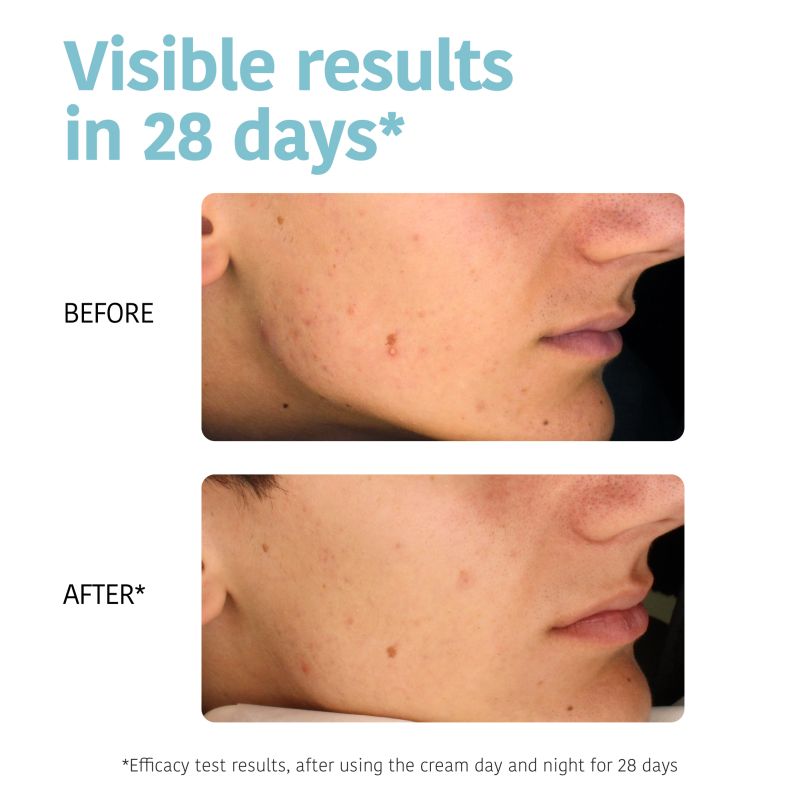 Crème Visage séborégulatrice & anti-imperfections-Acné Iroha 30ml
