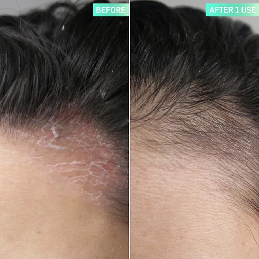 The Inkey List Salicylic Acid Exfoliating Scalp Treatment 150ml