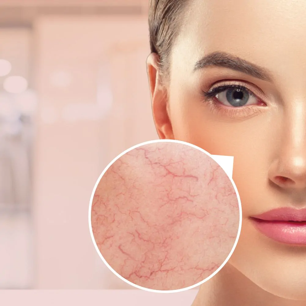Rode huid en kleine Adertjes Verzorgende crème 30ml