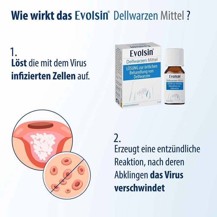 Evolsin Dellwarzen Mittel Lösung, 5 ml